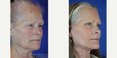 Laser Resurfacing before and after photo