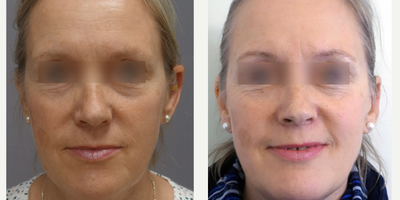 Ear Surgery before and after photo