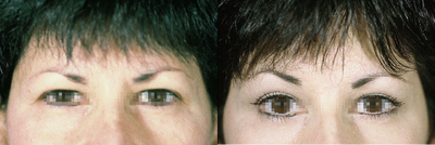Eyelid Surgery before and after photo