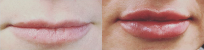 Lip Fillers before and after photo