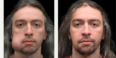 Lipoma Removal before and after photo