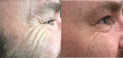 Botox before and after photo