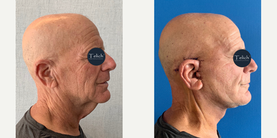 before and after image