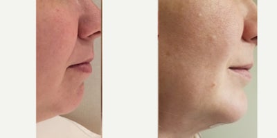 Chin Implant before and after photo