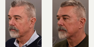 Eyelid Surgery before and after photo