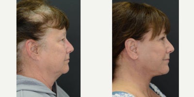 Eyelid Surgery before and after photo