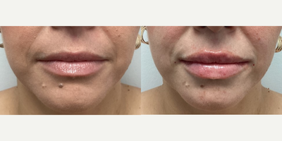 Lip Fillers before and after photo