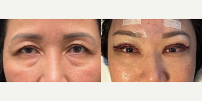 Brow Lift before and after photo
