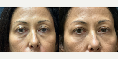 Eyelid Surgery before and after photo