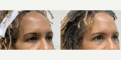 Eyelid Surgery before and after photo