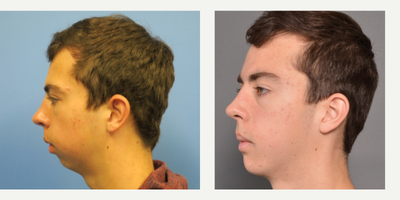 Genioplasty before and after photo