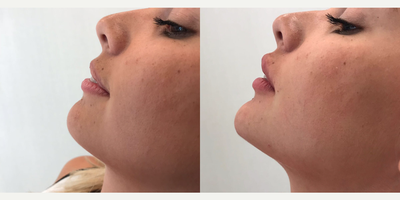 Juvederm before and after photo