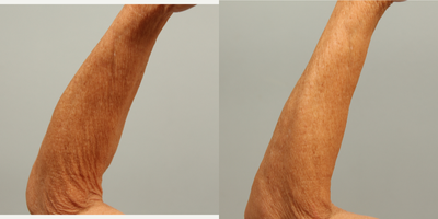 Arm Lift before and after photo