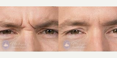 Botox before and after photo