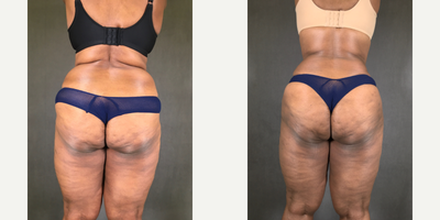 Liposuction before and after photo