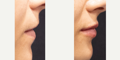 Restylane before and after photo