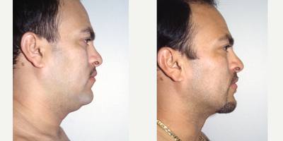 Liposculpture before and after photo