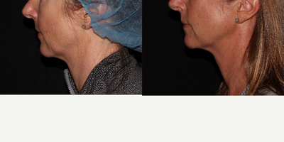 Thermage before and after photo