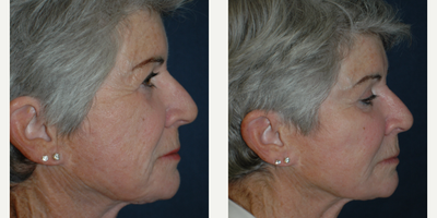 Bellafill before and after photo
