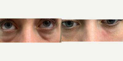 Belotero before and after photo