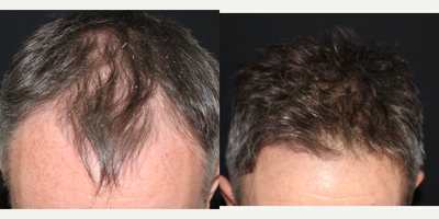 Hair Transplant before and after photo