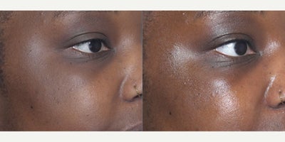 HydraFacial before and after photo