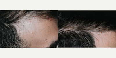 PRP for Hair Loss before and after photo