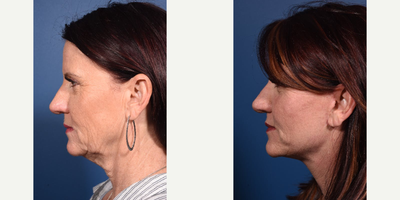 Lower Facelift before and after photo