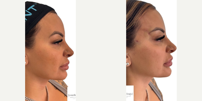 Thread Lift before and after photo