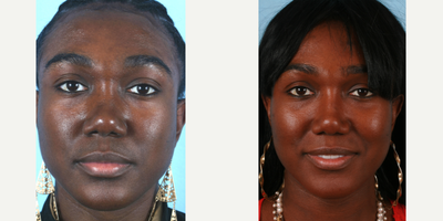 African American Rhinoplasty before and after photo