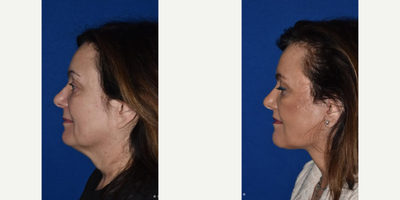 CO2 Laser before and after photo