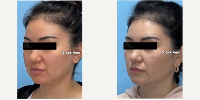 FaceTite before and after photo