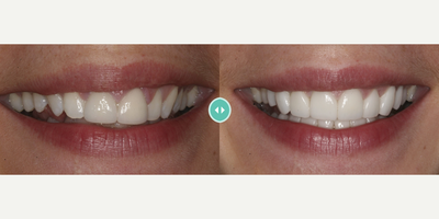 Porcelain Veneers before and after photo