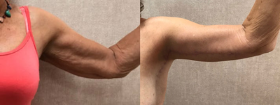 Arm Lift before and after photo