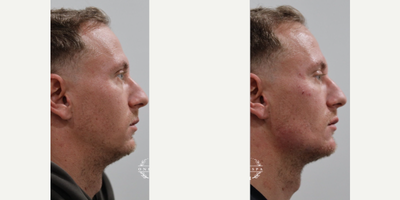 Bellafill before and after photo