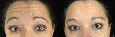 Botox before and after photo