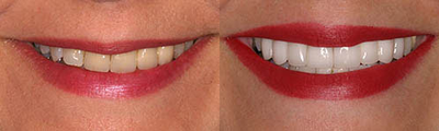 Dental Crown before and after photo