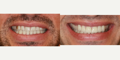 Dental Crown before and after photo