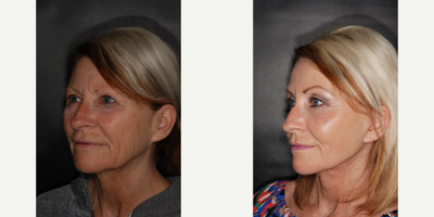Facelift before and after photo