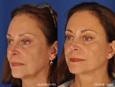 Facelift before and after photo