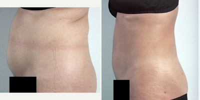 Liposuction before and after photo