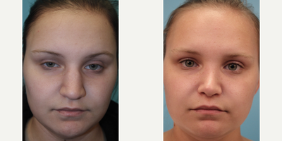 Rhinoplasty before and after photo
