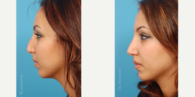 Rhinoplasty before and after photo