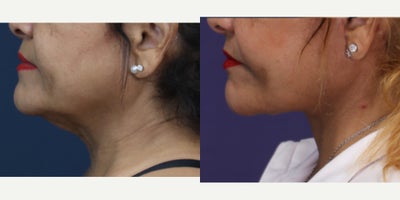 Neck Lift before and after photo