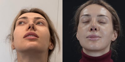 Revision Rhinoplasty before and after photo