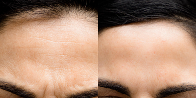 Botox before and after photo