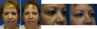 Eyelid Surgery before and after photo