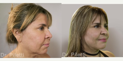 Facelift before and after photo