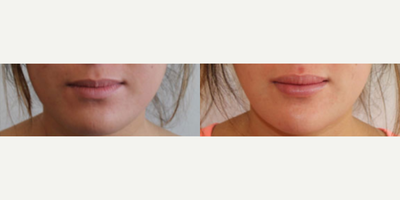 Lip Surgery before and after photo