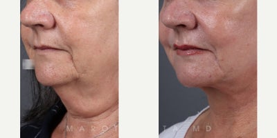 Neck Lift before and after photo